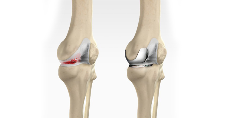 Contact Dr. Dhruv Patel for Joint Replacement Surgery Specialist in Navi Mumbai, Vashi & Belapur